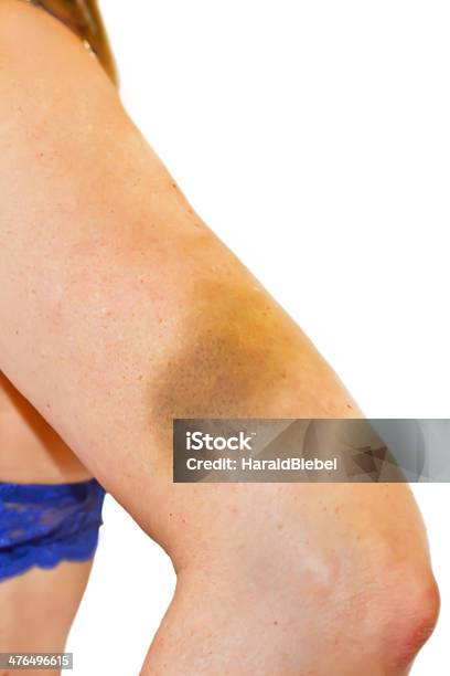 Foto de Mulher Com Um Hematoma No Seu Braço Esquerdo e mais fotos de stock de Abuso - Abuso, Acidente, Adulto