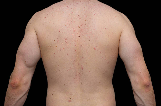 망 등근육, 스팟 문제 - acne back rear view men 뉴스 사진 이미지