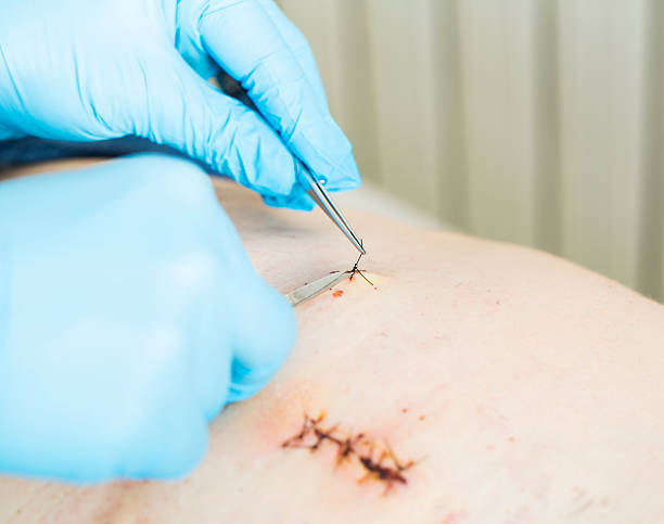 istock Nurse is removing stitches from a wound on patients chest 476539641