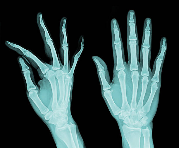 Rtg Normal Hand Rtg Medical Pictures Stock Photos, Pictures & Royalty-Free Images - iStock