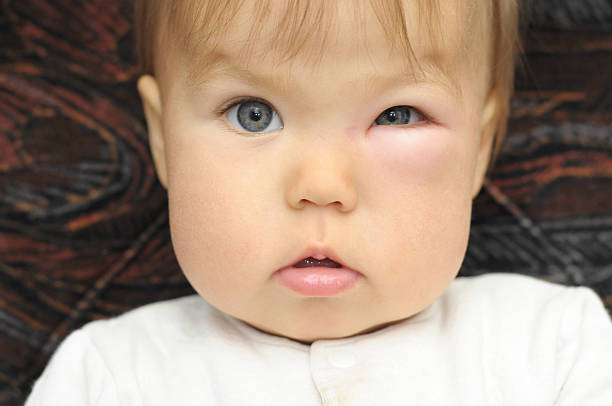 istock baby with a swollen eye from an insect bite 476612884