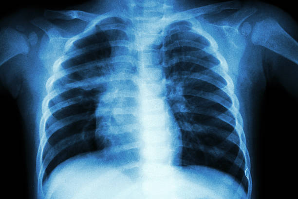 gruźlicy płuc - rib cage people x ray image x ray zdjęcia i obrazy z banku zdjęć