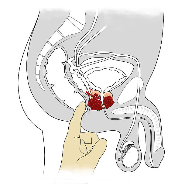 prostate cancer manual examination and cross-sectional view of prostate cancer male reproductive system cross section stock illustrations