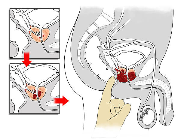 prostate cancer manual examination and cross-sectional view of prostate cancer male reproductive system cross section stock illustrations