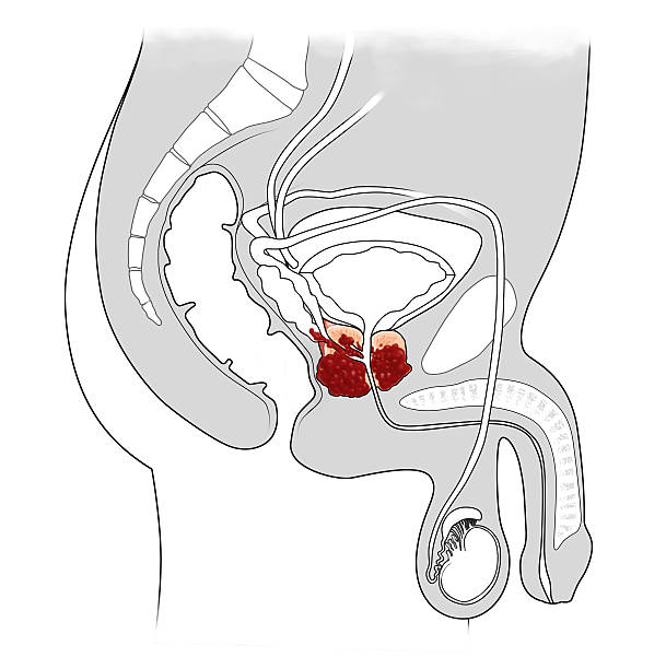 prostate cancer how it appears in sections of prostate cancer male reproductive system cross section stock illustrations