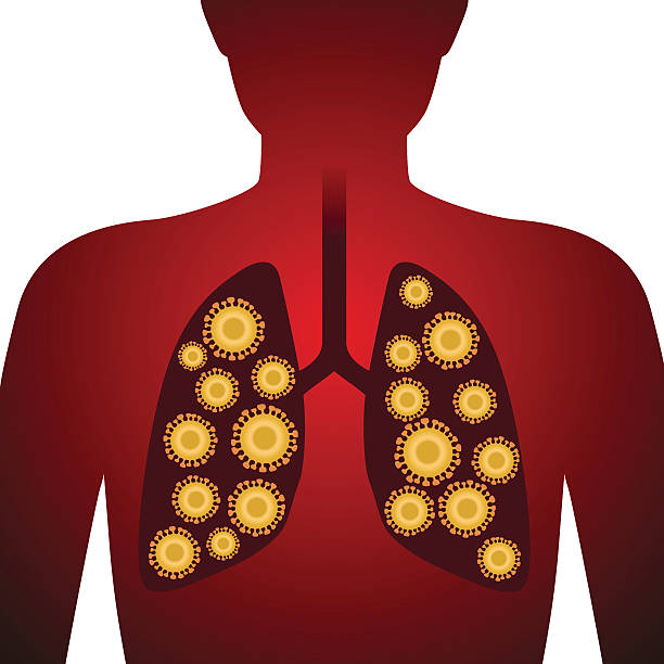 ilustrações, clipart, desenhos animados e ícones de vírus e contaminação ilustração de imagem - sudden acute respiratory syndrome human lung acute angle virus