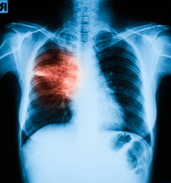 胸の x 線画像、pa uprigt 位置しています。 - pain rib cage x ray image chest ストックフォトと画像