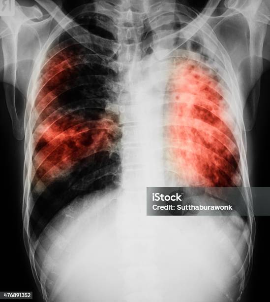 Foto de Peito Imagem De Raiox Do Paciente Com Pulmonar A Tuberculose e mais fotos de stock de 2015