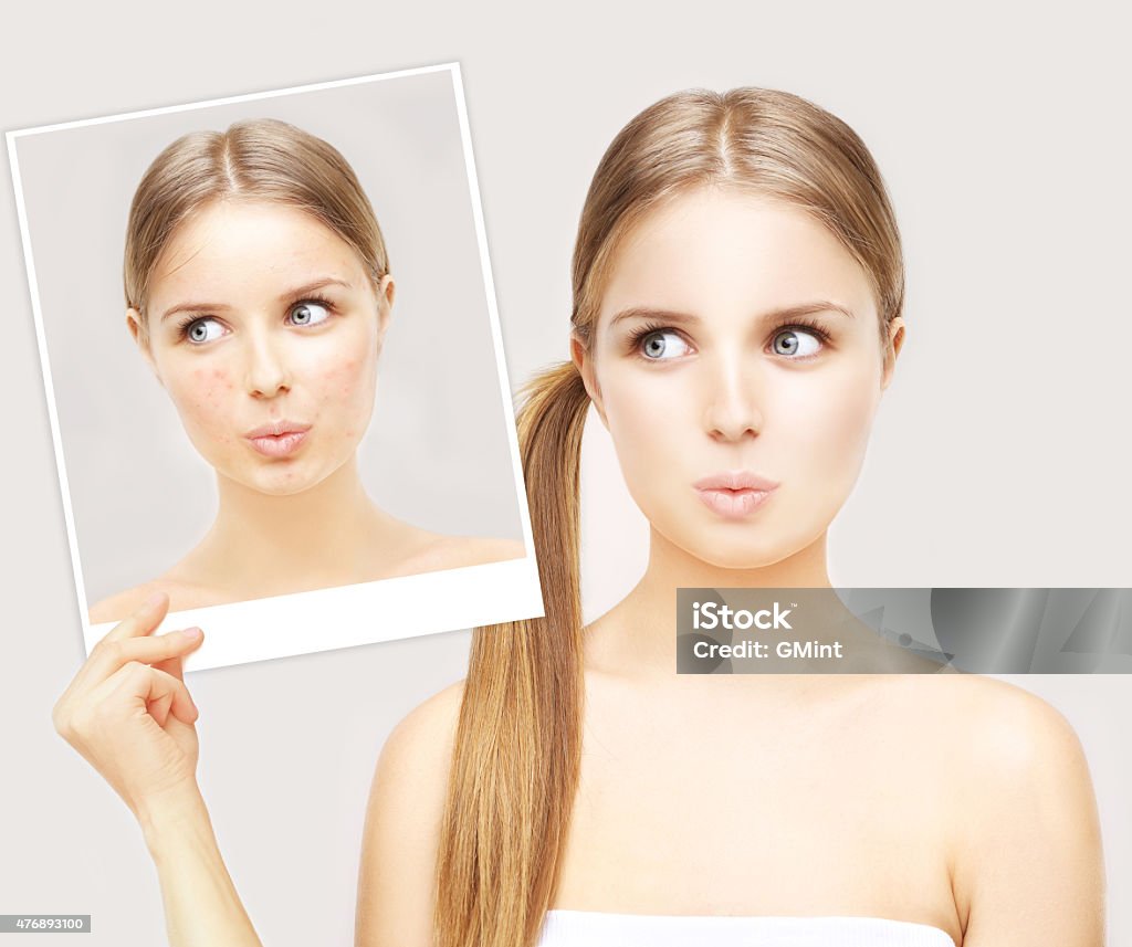 Girl with problem and clear skin. Portrait of beautiful teenage girl with problem and clear skin.Girl without and with makeup Rosacea - Skin Condition Stock Photo