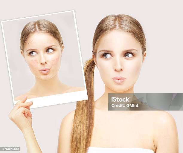 Girl With Problem And Clear Skin Stock Photo - Download Image Now - Rosacea - Skin Condition, Human Face, Photography