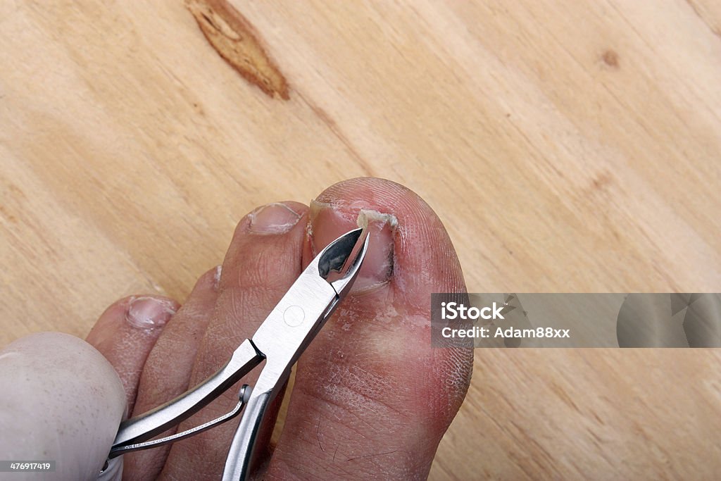 Broken puntera de las uñas - Foto de stock de Adulto libre de derechos