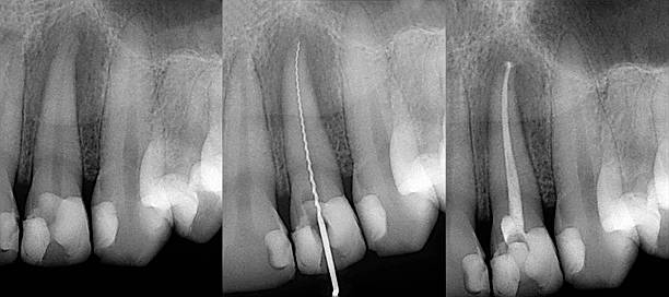 Before and after Endo treatment Dental X-ray stock photo