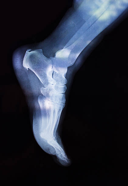 vista lateral do pé humano de raios x - bending human foot ankle x ray image - fotografias e filmes do acervo