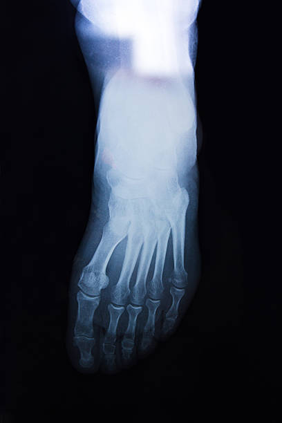 vue avant du pied humain de x-ray sur un fond noir - bending human foot ankle x ray image photos et images de collection