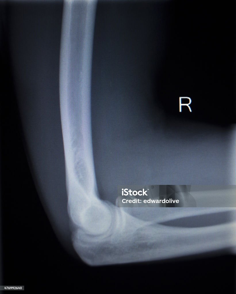 X-ray orthopedics Traumatology scan of elbow joint injury X-ray orthopedic medical CAT scan of painful tennis elbow injury in Traumatology hospital clinic. 2015 Stock Photo