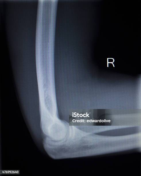 Xray Orthopedics Traumatology Scan Of Elbow Joint Injury Stock Photo - Download Image Now