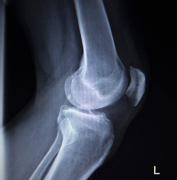 x-ray orthopedics scanner du genou douleur blessure ménisque jambe - x ray human knee orthopedic equipment human bone photos et images de collection