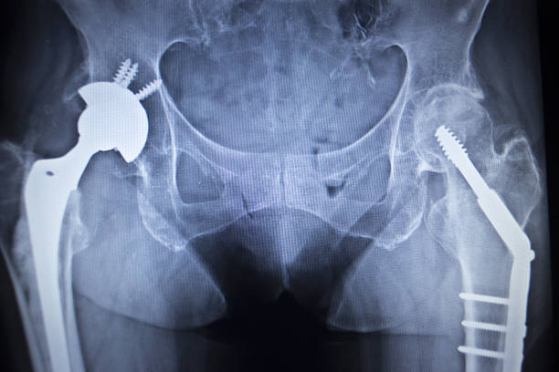 x 線スキャン画像の関節置換術整形腰インプラント - orthopedic equipment osteoporosis x ray human spine ストックフォトと画像