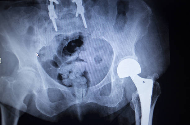 x-선 촬영 이미지 엉덩관절 인공관절 정형외과 임플란트 - orthopedic equipment osteoporosis x ray human spine 뉴스 사진 이미지