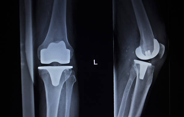 x-ray skanowania ortopedia kolan łękotka prosthetics wszczepiania - x ray human knee orthopedic equipment human bone zdjęcia i obrazy z banku zdjęć