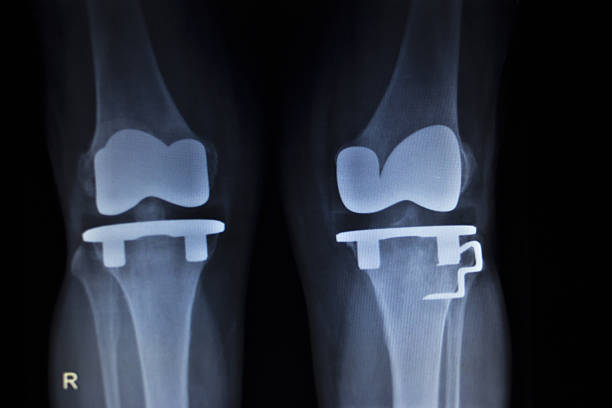 x-ray skanowania ortopedia kolan łękotka prosthetics wszczepiania - x ray human knee orthopedic equipment human bone zdjęcia i obrazy z banku zdjęć