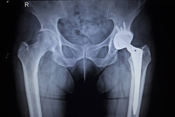 x-선 촬영 이미지 엉덩관절 인공관절 정형외과 임플란트 - orthopedic equipment osteoporosis x ray human spine 뉴스 사진 이미지