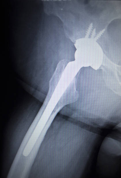 x 線スキャン画像の関節置換術整形腰インプラント - orthopedic equipment osteoporosis x ray human spine ストックフォトと画像