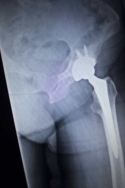 x 線スキャン画像の関節置換術整形腰インプラント - orthopedic equipment osteoporosis x ray human spine ストックフォトと画像