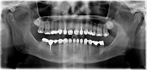 Panoramic X-ray of teeth and jaw. Black and white photo.