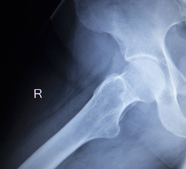 istock X-ray orthopedic scan  image of hip joints human skeleton 477139324