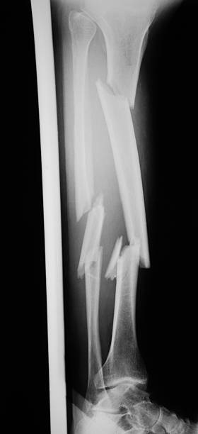 istock X-ray image of broken lag, lateral view. 477176938
