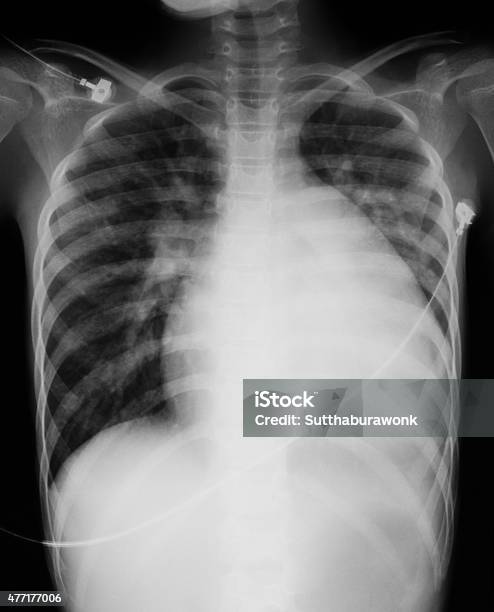 Foto de Peito Imagem De Raios X De Um Jovem Rapaz e mais fotos de stock de 2015 - 2015, Abdômen Humano, Alvéolos