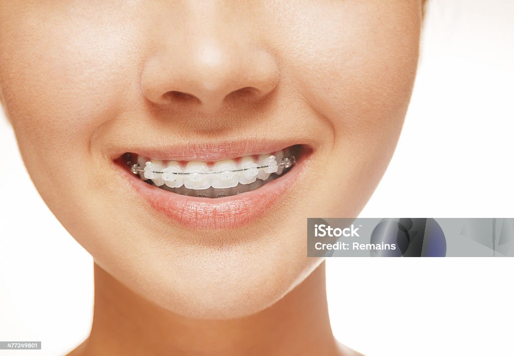 Braces on teeth, close-up Woman smile: teeth with braces, dental care concept, front view Adult Stock Photo