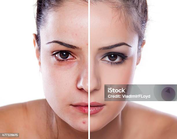 Before And After Stock Photo - Download Image Now - In Front Of, Acne, Animal Head