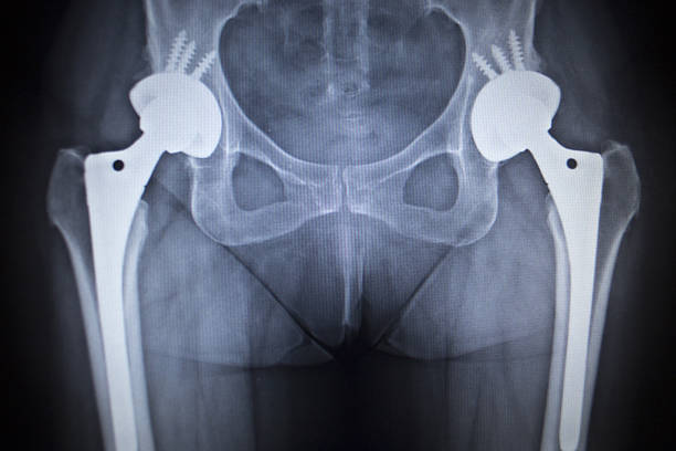 x 線スキャン画像の関節置換術整形腰インプラント - orthopedic equipment osteoporosis x ray human spine ストックフォトと画像