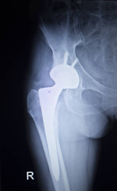 istock X-ray scan  image of hip joint replacement orthopedic implant 477365880