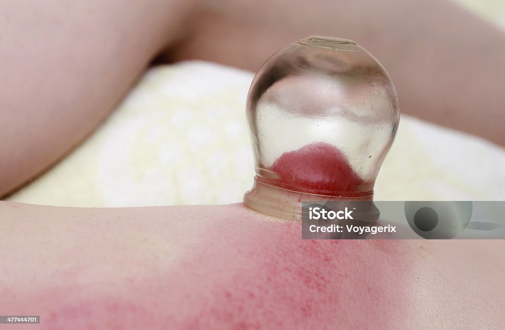Alternative medicine. Fire cupping massage detail on woman's back Alternative medicine health care. Fire cupping procedure, woman receiving vacuum cupping massage treatment, detail on female back. Acupuncture Stock Photo