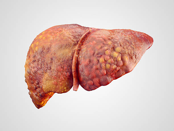 realistic illustration of cirrhosis of human liver - medische aandoening fotos stockfoto's en -beelden