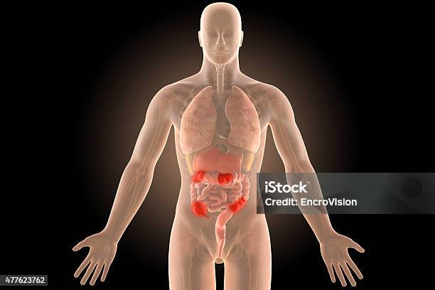 3d Human Body Crohns Infection Sites Colon With Clipping Path Stock Photo - Download Image Now