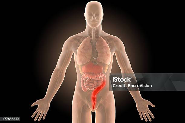 3d Ulcerative Colitis Proctosigmoiditis Infection With Clipping Path Stock Photo - Download Image Now