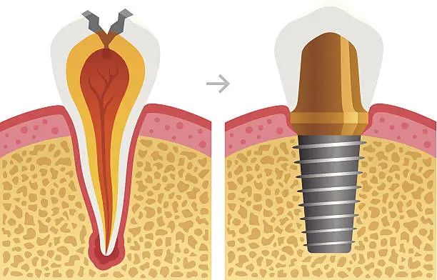 Vector illustration of Dental Cavity Fixed With Implant