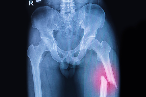 Fractured Femur, Broken thigh x-rays image