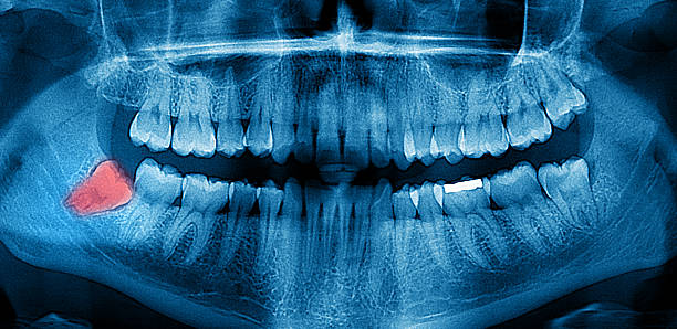 dental x-ray panoramablick - x ray dental hygiene dentist x ray image stock-fotos und bilder