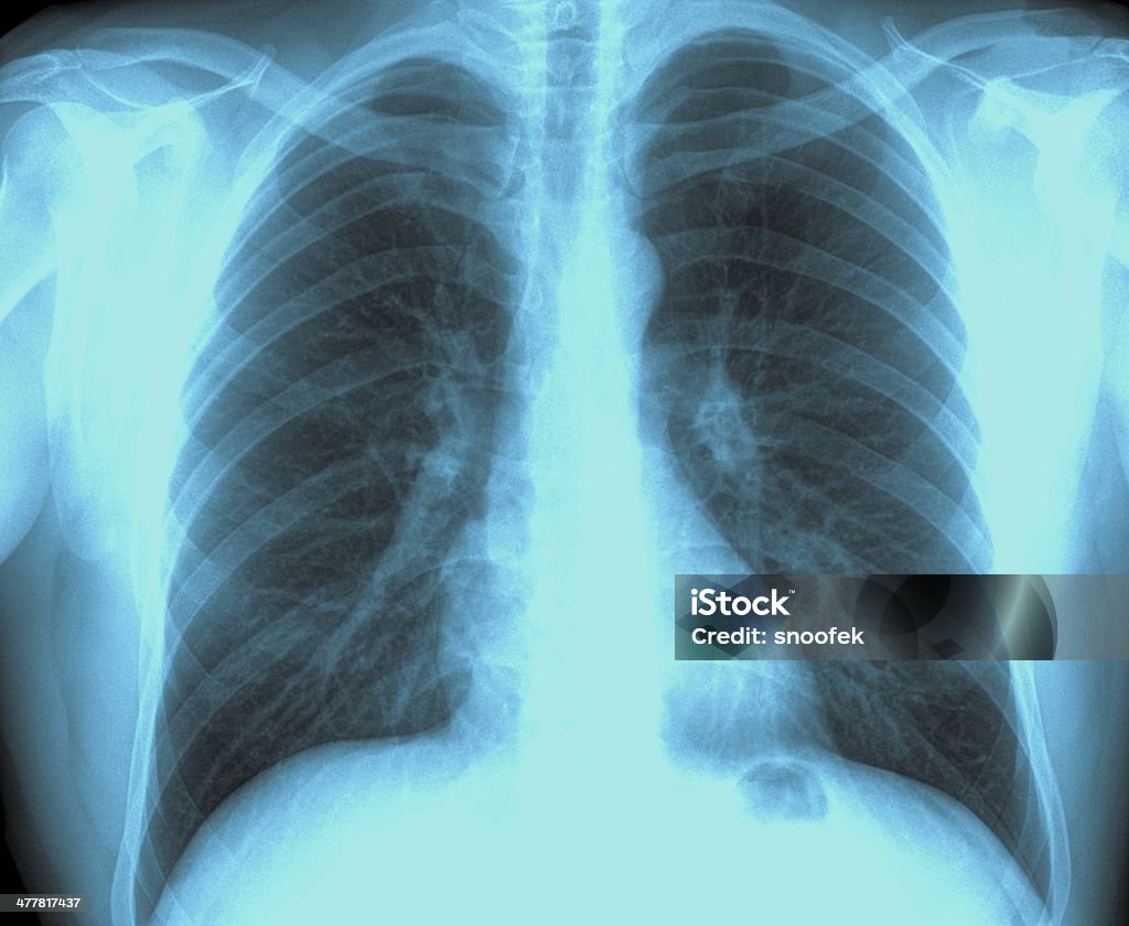 X-Ray Image Healthy Chest Chest - Torso Stock Photo