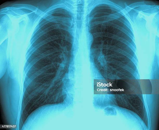 Xray Image Healthy Chest Stock Photo - Download Image Now - Chest - Torso, Routine, X-ray Image