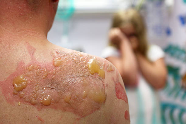 back with second degree burn #2 - verbrand stockfoto's en -beelden