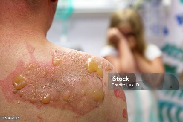 Back With Second Degree Burn 2 Stock Photo - Download Image Now - Burning, Child, Wound