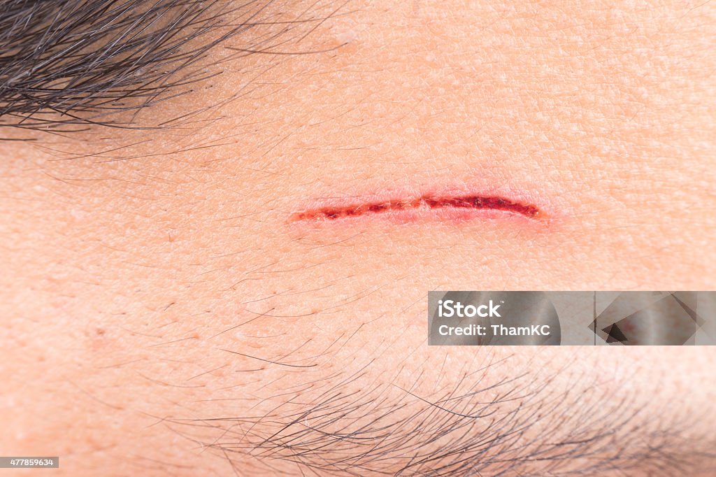 痛みのクローズアップの巻線で額から深めのカット - 傷のロイヤリティフリーストックフォト
