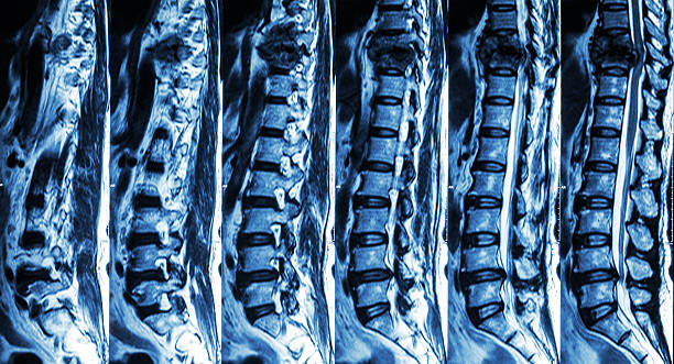 흉부 척추 골절 및 압축 척수 - human spine mri scan x ray doctor 뉴스 사진 이미지