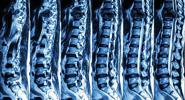 fracture of thoracic spine and compress spinal cord MRI of Lumbar & Thoracic spine : show fracture of thoracic spine and compress spinal cord ( Myelopathy ) animal spine stock pictures, royalty-free photos & images